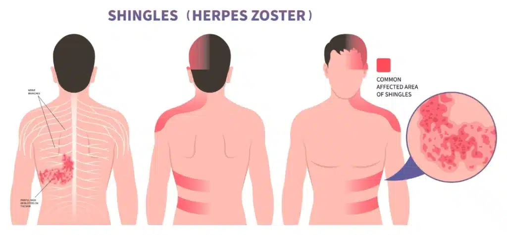 Herpes Vs Shingles Dr Ben Medical Men s Health Clinic Women s 